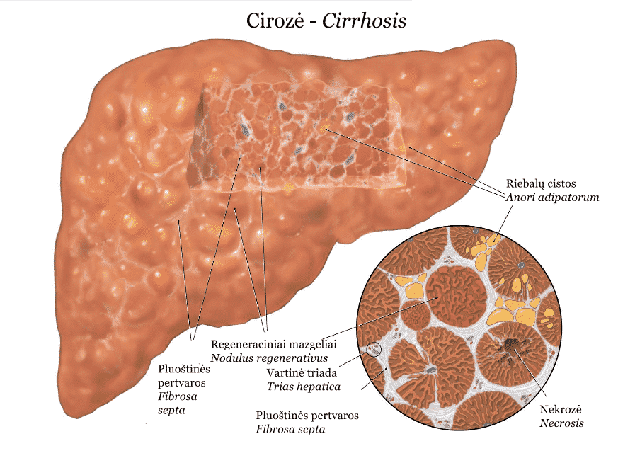 Гепатит и цирроз